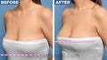 Pro Sagging Correction Breast Upright Lifter