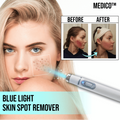 Blue Light Skin Spot Remover